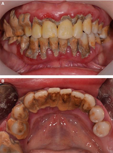 Dental Calculus Archaeology