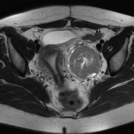 Ovarian fibrothecoma | Radiology Case | Radiopaedia.org