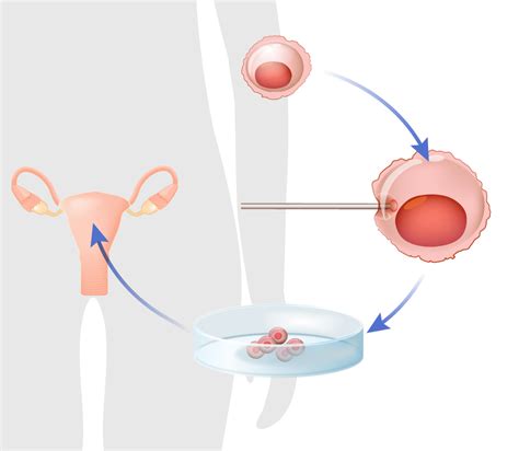 Egg Donation Process - Encino, CA - Bakersfield, CA - Los Angeles, CA - Los Angeles Reproductive ...