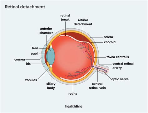 Retinal Detachment: Symptoms, Signs, Causes, and More Posterior Vitreous Detachment, Optical ...