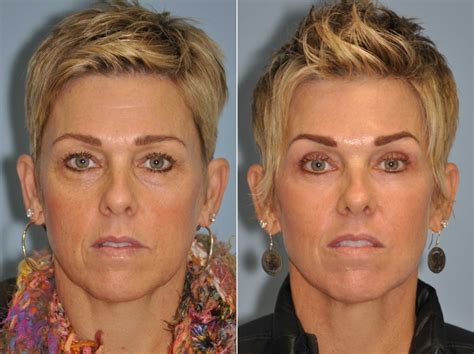 Blepharoplasty photos | Chevy Chase, MD | Patient 13041