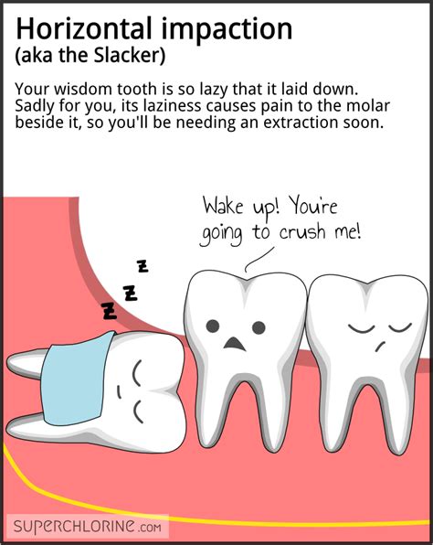 Impacted Wisdom Tooth