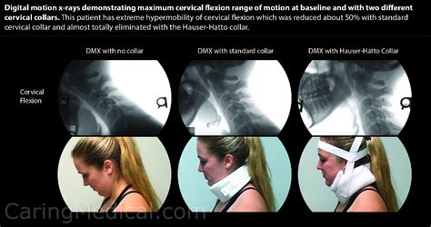 Treating Vertebrobasilar insufficiency, vertebrobasilar artery ...