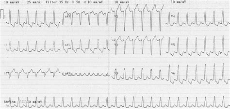 VT versus SVT • LITFL Medical Blog • ECG Library Basics