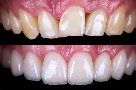 What Is A Tooth Veneer at Oliver Corral blog