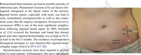 Ilioinguinal Nerve Sensory Distribution