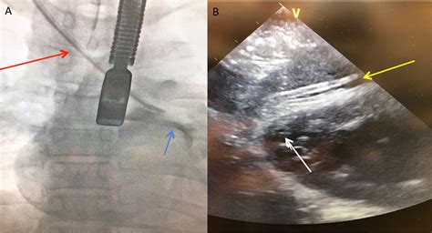 Pericardial Placement of a Mediport Catheter - Journal of Cardiothoracic and Vascular Anesthesia