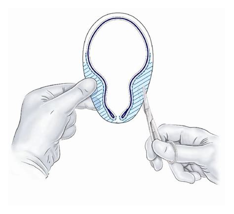 The mesh is placed medially in the preperitoneal space. | Download ...