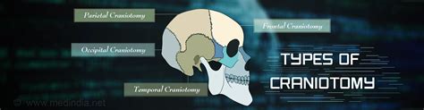 Craniotomy - Types, Indications, Procedure, Complications