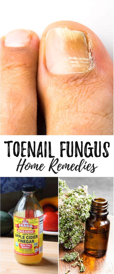 9 Best Candida images in 2020 | Toenail fungus remedies, Toenail fungus ...