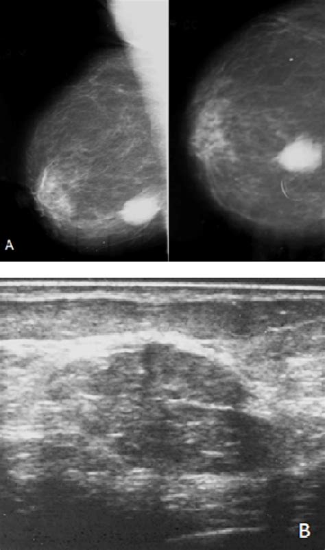 Accuracy of subcategories A, B, C in BI-RADS 4 lesions by combined mammography and breast ...