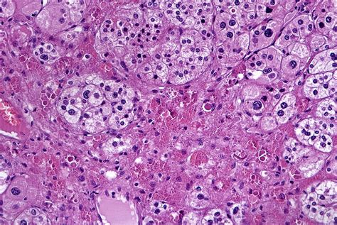 Thyroid Adenoma Histology