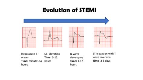 STEMI (ST Elevation Myocardial Infarction): Diagnosis,, 52% OFF