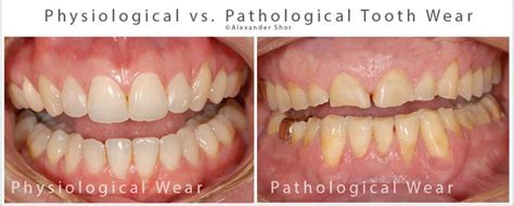 Tooth Wear Treatment Seattle - Shor Dental