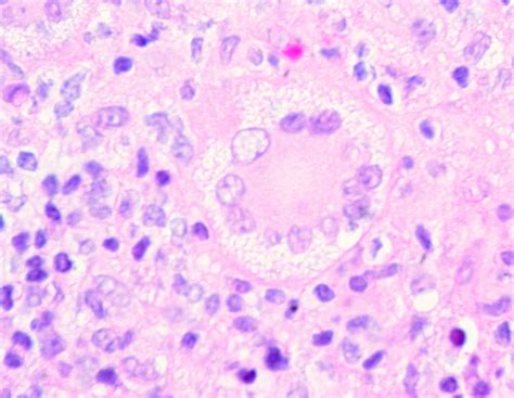 Touton Giant Cell | In a juvenile xanthogranuloma from the n… | Flickr