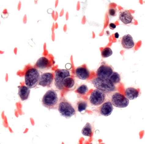 Larger cells with nucleoli in Large cell neuroendocrine carcinoma ...