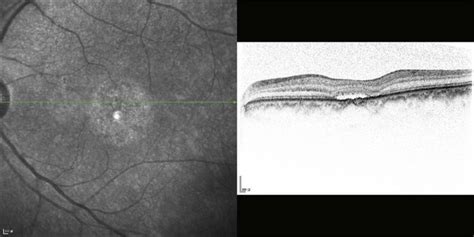 Central Serous Chorioretinopathy | Ento Key