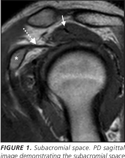 [PDF] Shoulder Impingement and Associated MRI Findings | Semantic Scholar