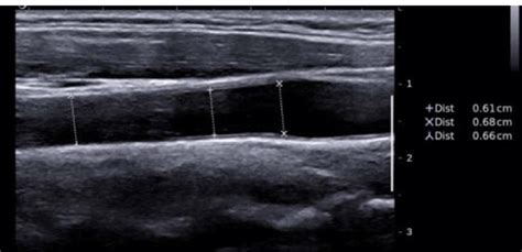 16 – Example of an ultrasound image of the common carotid artery ...