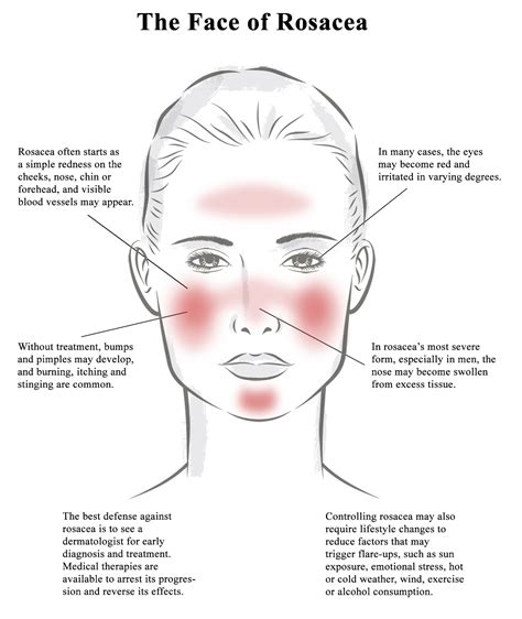 It’s Becoming Clear: Rosacea Awareness Month Highlights Potential ...