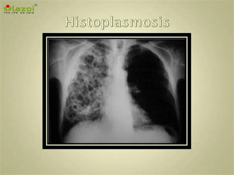 PPT - Histoplasmosis (fungal infection of the lungs): Symptoms, causes ...