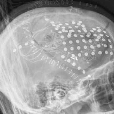 A radiograph demonstrating one possible placement of ECoG electrodes | Download Scientific Diagram