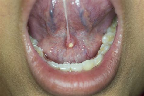 Salivary gland disorders and tumours - Revise Dental