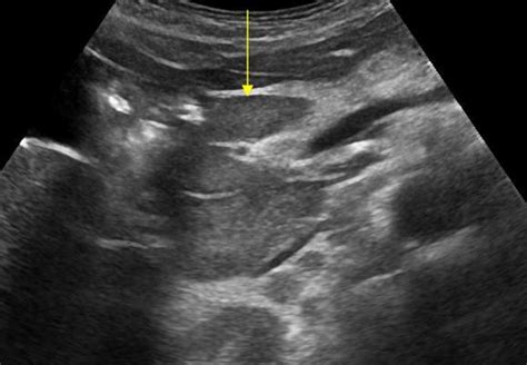 Abdomen and retroperitoneum | 1.7 Peritoneum mesentery and omentum : Case 1.7.2 Mesenteric lymph ...