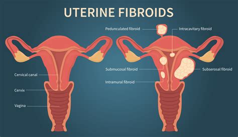 Uterine Fibroid Embolization Specialist - Los Angeles, CA & Encino, CA: LA Vascular Specialists ...