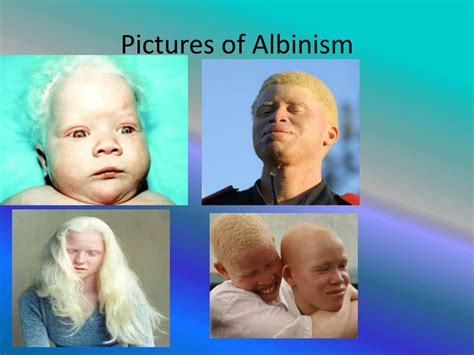 PPT - ALBINISM PowerPoint Presentation, free download - ID:2478002