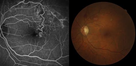 Branch Retinal Vein Occlusion (BRVO) - Northern Sydney Cataract