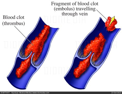 STOCK IMAGE, illustration of a venous thrombus and embolus cutaway ...