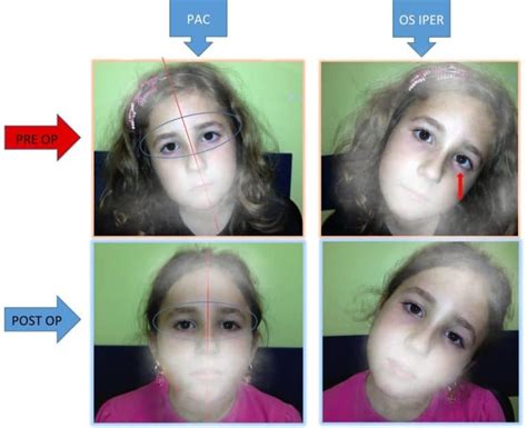 Ocular Torticollis - Abnormal Compensatory Head Posture