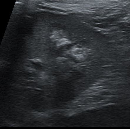 Medullary nephrocalcinosis | Image | Radiopaedia.org