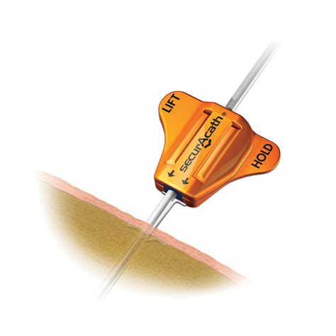 Subcutaneous Engineered Stabilization Device SecurAcath® supplies ...