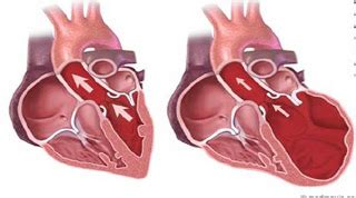 HHD Hypertensive Heart Disease - 5 Nursing Diagnosis Interventions ...