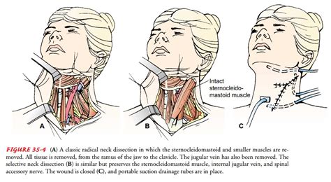 Neck Dissection