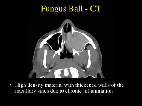 PPT - Fungal Sinusitis: An Overview PowerPoint Presentation, free ...