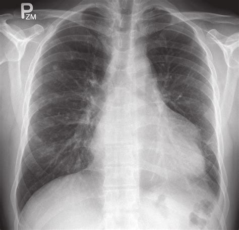 Normal Vs Abnormal Chest X Ray