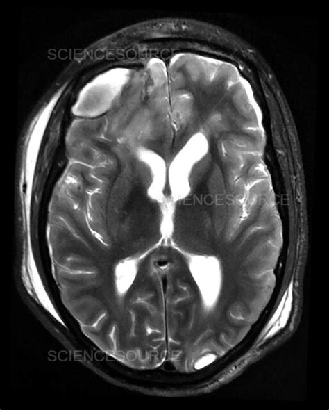 Traumatic Brain Injury MRI | Stock Image - Science Source Images