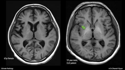 Ultimate Radiology : Bilateral basal ganglia T1 hyperintensity