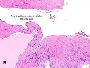 American Urological Association - Simple Cortical Cyst