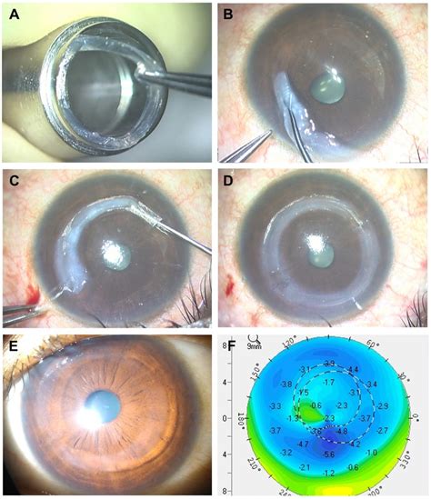 ESCRS - Everything you need to know about New treatments for keratoconus