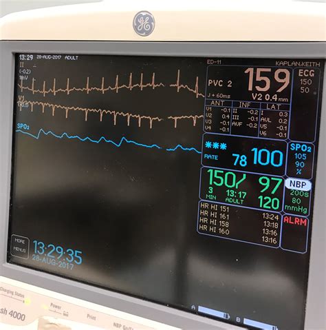 Cardiac Monitor – Tissuepathology.com