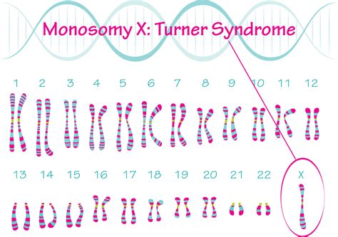 Turner Syndrome Karyotype Monosomy X 7818639 Vector Art at Vecteezy