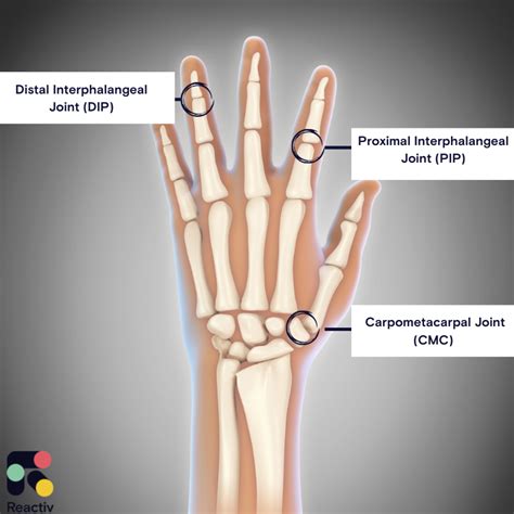 Hand Osteoarthritis: What are the Symptoms? What are the Treatments ...