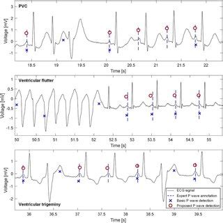 Example of P waves detection in ECGs with various pathologies. Top ...