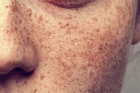 The Difference Between Melasma and Other Skin Spots | The Healthy