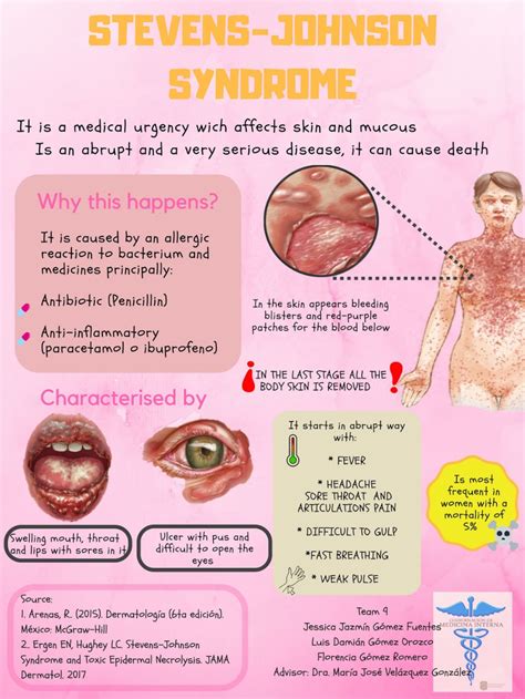 Toxic Epidermal Necrolysis (TEN) Stevens-Johnson Syndrome (SJS - Google Search | Steven johnson ...