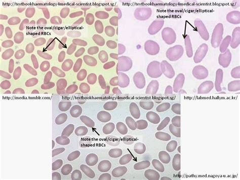 Haematology in a NutShell: Elliptocytes/Ovalocytes | Hematology, Medical laboratory science ...